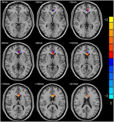 Abnormal Reginal Homogeneity in Left Anterior Cingulum Cortex and Precentral Gyrus as a Potential Neuroimaging Biomarker for First-Episode Major Depressive Disorder